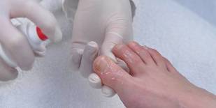 how to treat a nail fungus