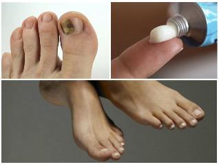 nail fungus of the feet ointments