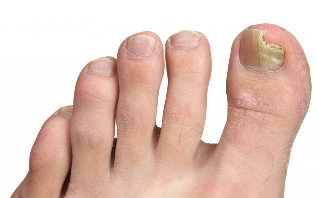 nail fungus of the feet stage