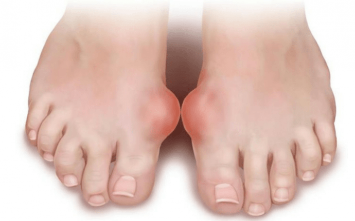 foot deformity as a cause of the appearance of fungus on the legs