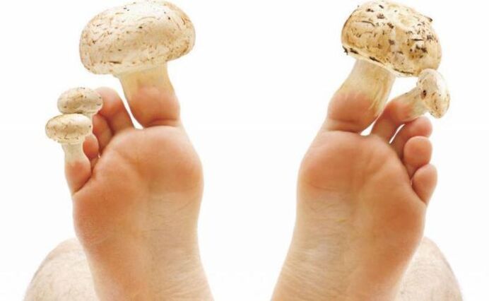 foot fungus causes, symptoms and treatment