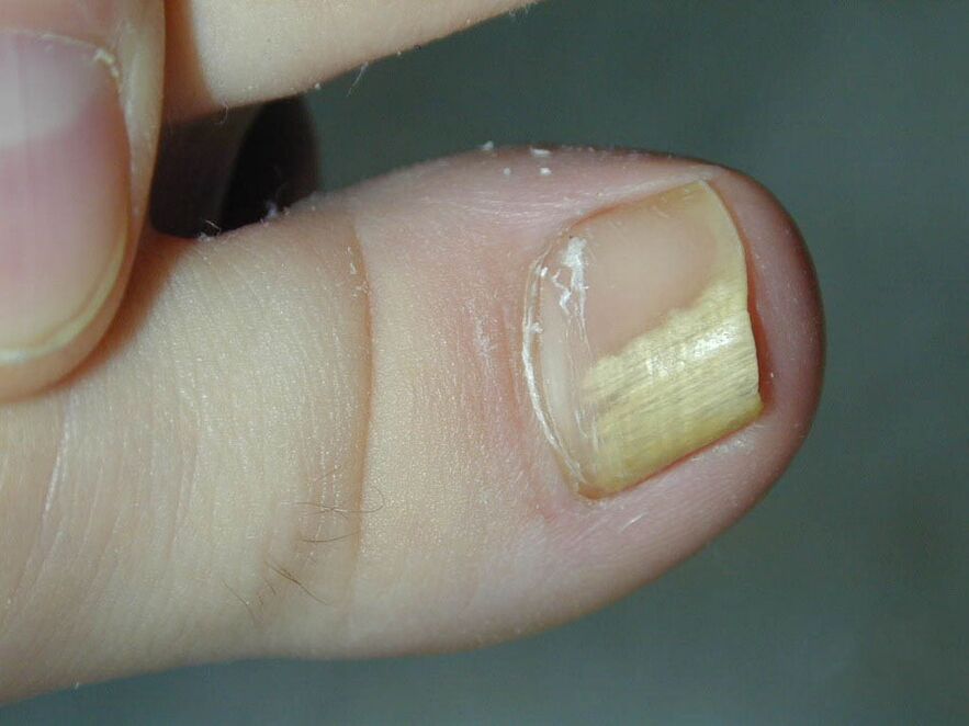 Symptom of the fungus - discoloration of the nail