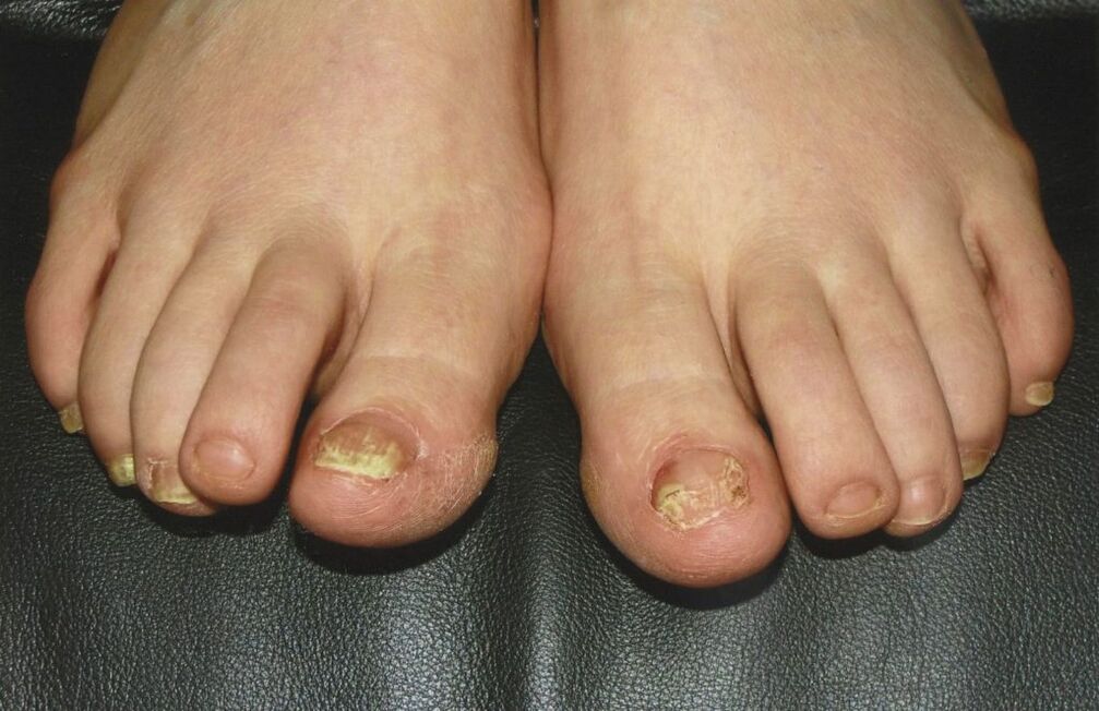 toenail fungus