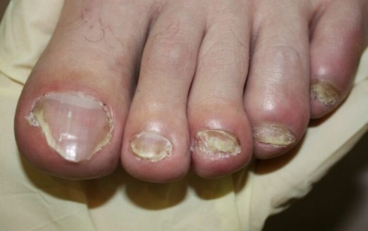 Nail fungus