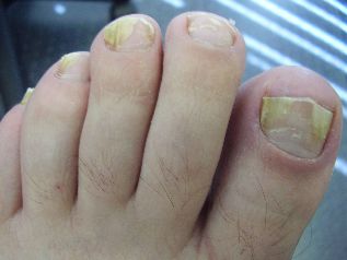 fungal infections of the feet