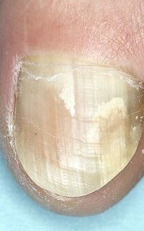 Nail fungus