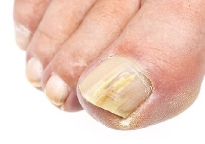 What the nail fungus is waiting for