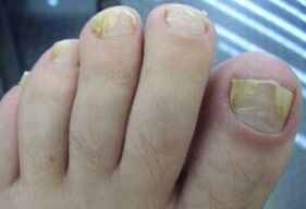 Struck by the nail with fungal infections