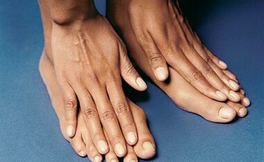 How to treat a mushroom on fingers