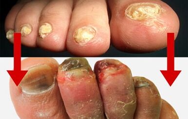 Mushroom manifestations on fingers