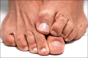 itchy skin on the feet due to a fungal infection of the nails