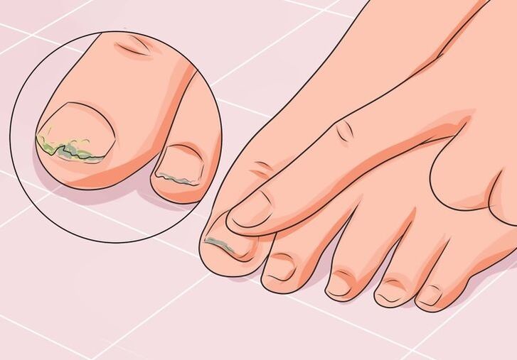 how to treat toenail fungus with drops