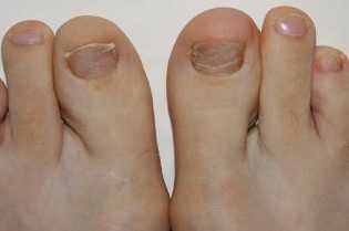 The symptoms of the onset of the fungal infection of the feet