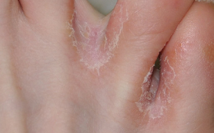the fungus of the skin on the feet