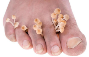 Fungal infections of the feet