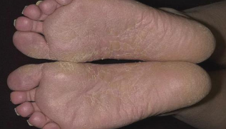 Mycosis of the feet