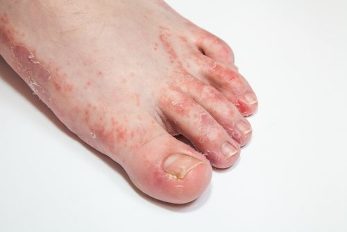 mycosis of the feet and nails